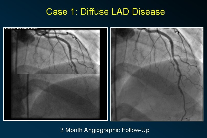 Case 1: Diffuse LAD Disease 3 Month Angiographic Follow-Up 