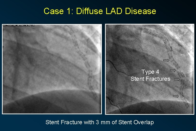 Case 1: Diffuse LAD Disease Type 4 Stent Fractures Stent Fracture with 3 mm