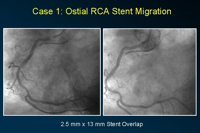 Case 1: Ostial RCA Stent Migration 2. 5 mm x 13 mm Stent Overlap