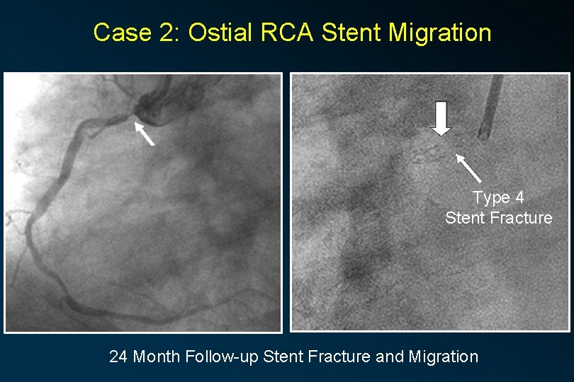 Case 2: Ostial RCA Stent Migration Type 4 Stent Fracture 24 Month Follow-up Stent