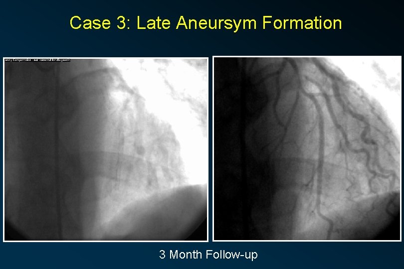 Case 3: Late Aneursym Formation 3 Month Follow-up 