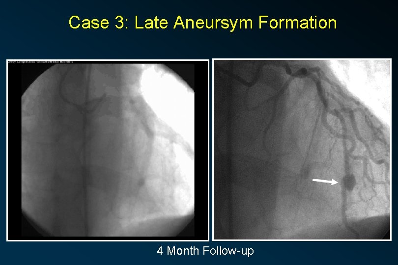 Case 3: Late Aneursym Formation 4 Month Follow-up 