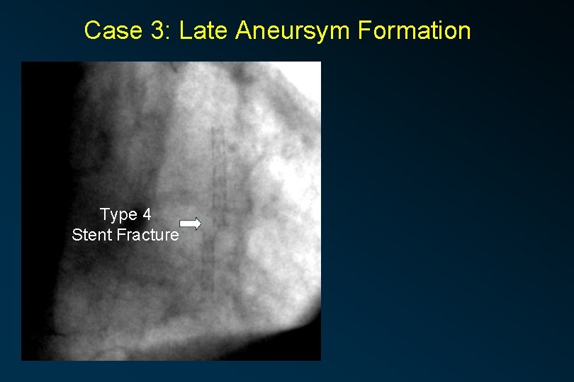 Case 3: Late Aneursym Formation Type 4 Stent Fracture 