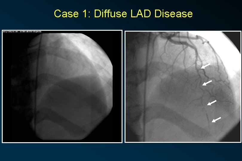Case 1: Diffuse LAD Disease 