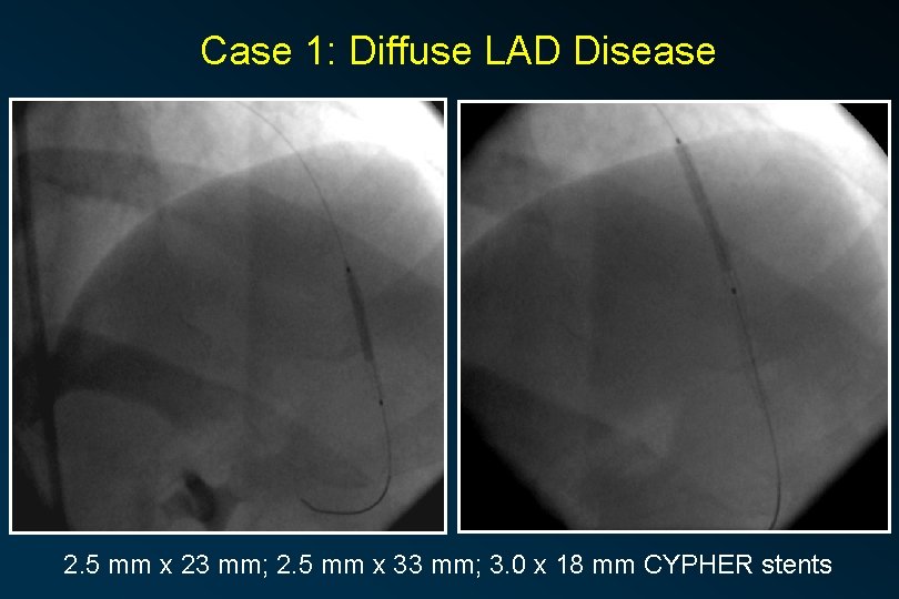 Case 1: Diffuse LAD Disease 2. 5 mm x 23 mm; 2. 5 mm