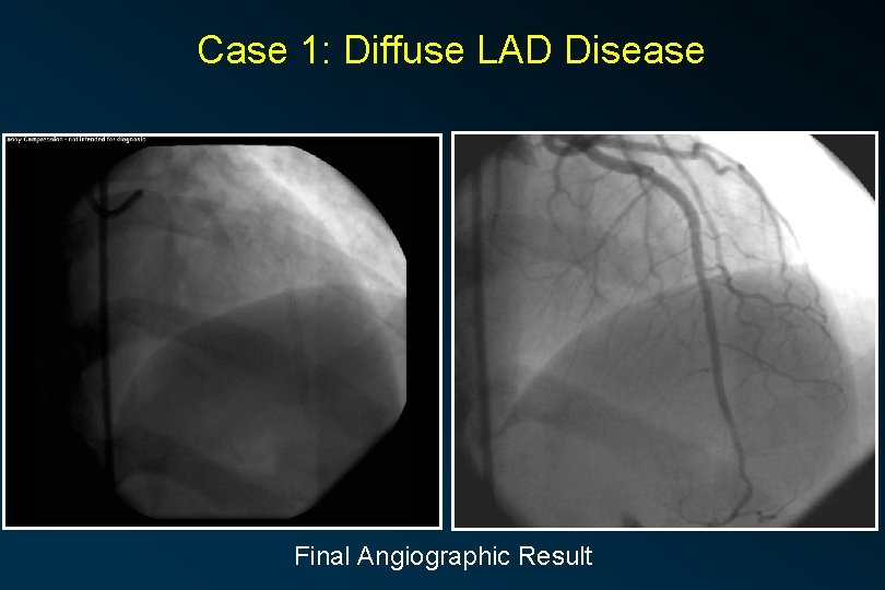 Case 1: Diffuse LAD Disease Final Angiographic Result 