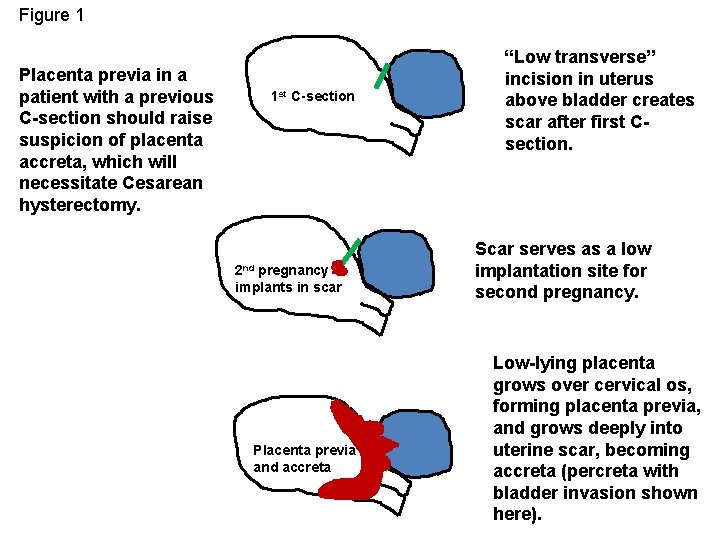 Figure 1 Placenta previa in a patient with a previous C-section should raise suspicion Figure 1 Placenta previa in a patient with a previous C-section should raise suspicion