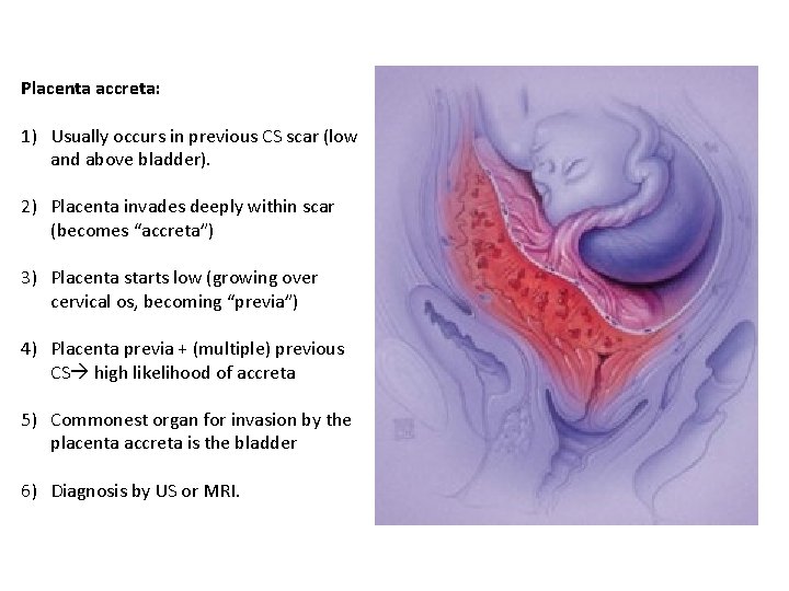 Placenta accreta: 1) Usually occurs in previous CS scar (low and above bladder). 2) Placenta accreta: 1) Usually occurs in previous CS scar (low and above bladder). 2)