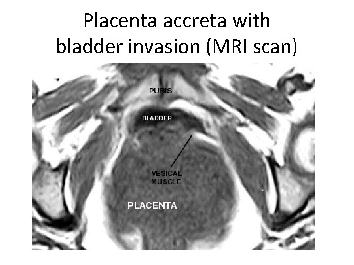 Placenta accreta with bladder invasion (MRI scan) Placenta accreta with bladder invasion (MRI scan)