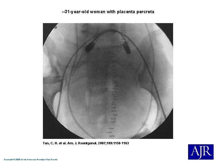 --31 -year-old woman with placenta percreta Tan, C. H. et al. Am. J. Roentgenol. --31 -year-old woman with placenta percreta Tan, C. H. et al. Am. J. Roentgenol.