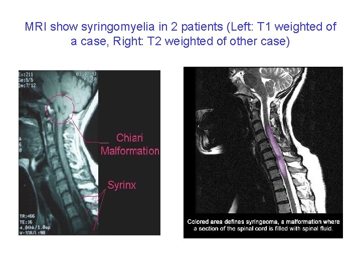 MRI show syringomyelia in 2 patients (Left: T 1 weighted of a case, Right: