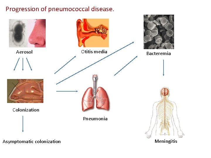 Progression of pneumococcal disease. Aerosol Otitis media Bacteremia Colonization Pneumonia Asymptomatic colonization Meningitis 