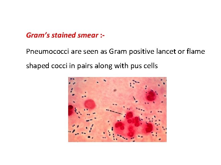 2. Microscopy -> Gram’s stained smear : Pneumococci are seen as Gram positive lancet