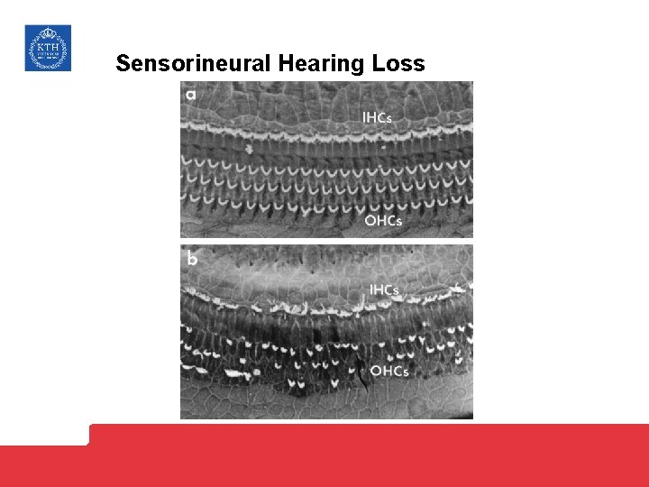 Sensorineural Hearing Loss 