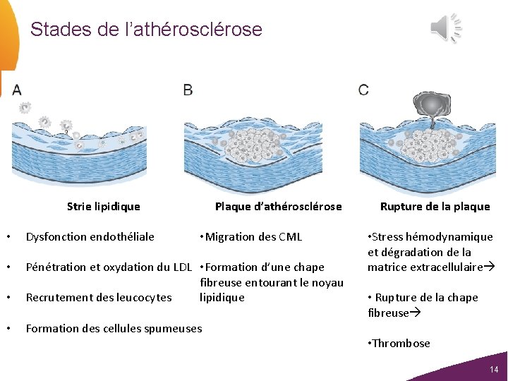 Stades de l’athérosclérose Strie lipidique Plaque d’athérosclérose • Dysfonction endothéliale • Migration des CML