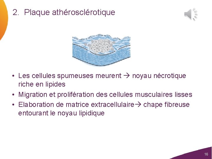 2. Plaque athérosclérotique • Les cellules spumeuses meurent noyau nécrotique riche en lipides •