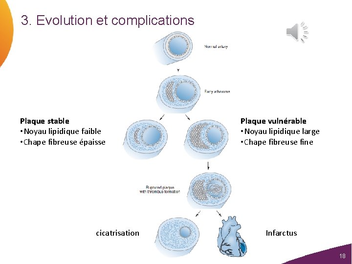 3. Evolution et complications Plaque stable • Noyau lipidique faible • Chape fibreuse épaisse 3. Evolution et complications Plaque stable • Noyau lipidique faible • Chape fibreuse épaisse