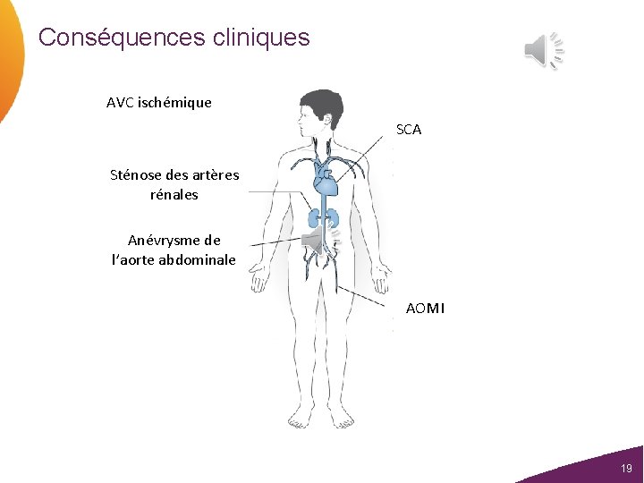 Conséquences cliniques AVC ischémique SCA Sténose des artères rénales Anévrysme de l’aorte abdominale AOMI