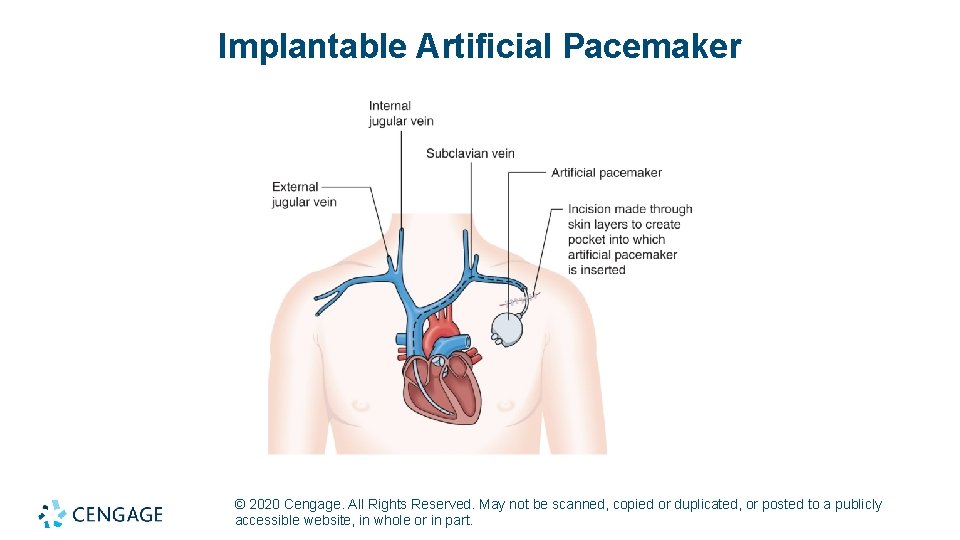 Implantable Artificial Pacemaker © 2020 Cengage. All Rights Reserved. May not be scanned, copied