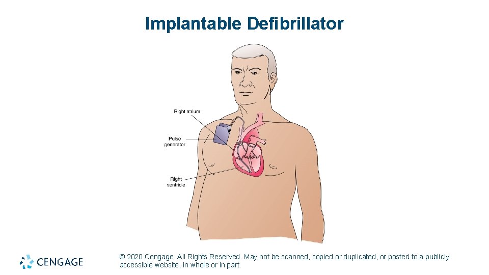 Implantable Defibrillator © 2020 Cengage. All Rights Reserved. May not be scanned, copied or