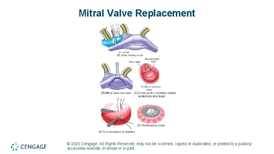 Mitral Valve Replacement © 2020 Cengage. All Rights Reserved. May not be scanned, copied