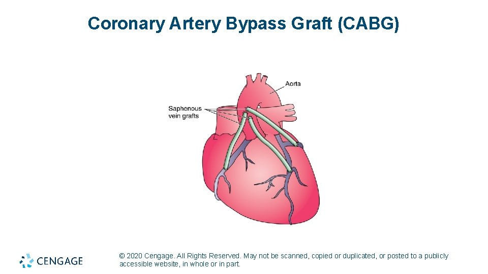 Coronary Artery Bypass Graft (CABG) © 2020 Cengage. All Rights Reserved. May not be