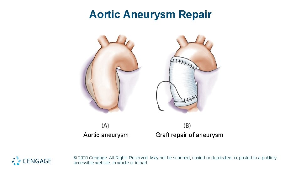 Aortic Aneurysm Repair Aortic aneurysm Graft repair of aneurysm © 2020 Cengage. All Rights