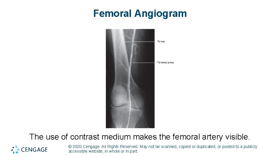 Femoral Angiogram The use of contrast medium makes the femoral artery visible. © 2020