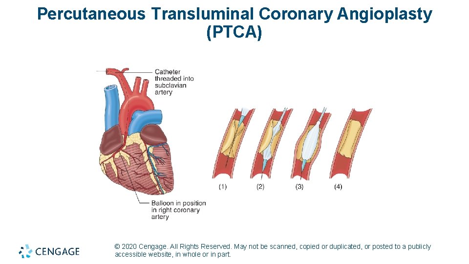 Percutaneous Transluminal Coronary Angioplasty (PTCA) © 2020 Cengage. All Rights Reserved. May not be
