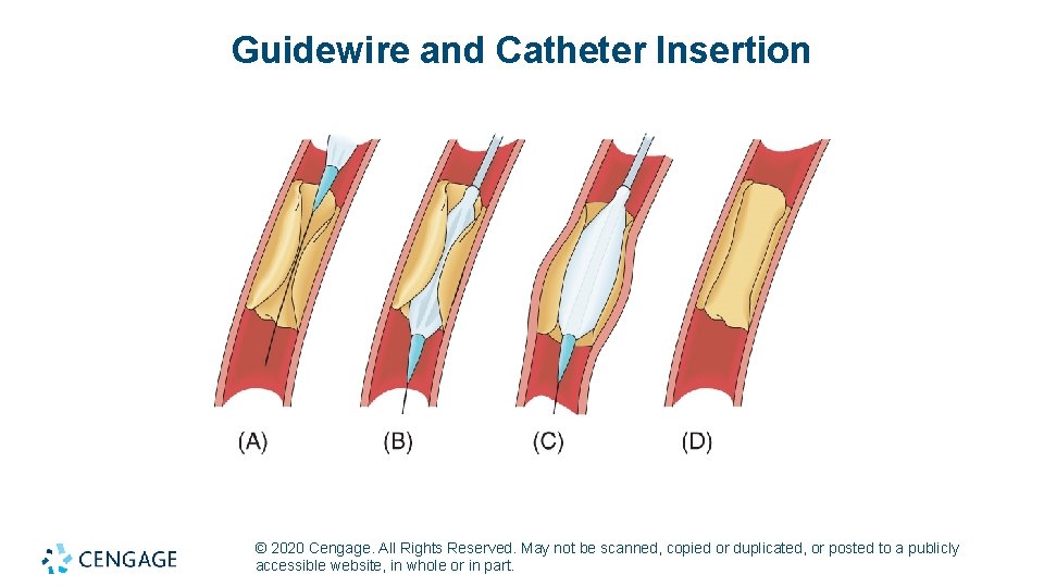 Guidewire and Catheter Insertion © 2020 Cengage. All Rights Reserved. May not be scanned,