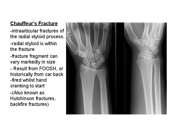 Chauffeur’s Fracture -intraarticular fractures of the radial styloid process. -radial styloid is within the