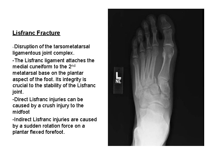 Lisfranc Fracture -Disruption of the tarsometatarsal ligamentous joint complex. -The Lisfranc ligament attaches the