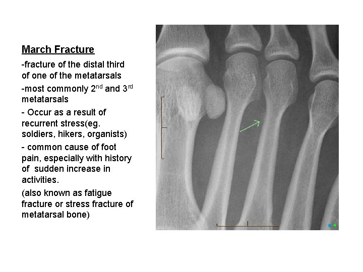 March Fracture -fracture of the distal third of one of the metatarsals -most commonly