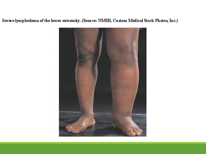 Severe lymphedema of the lower extremity. (Source: NMSB, Custom Medical Stock Photos, Inc. )