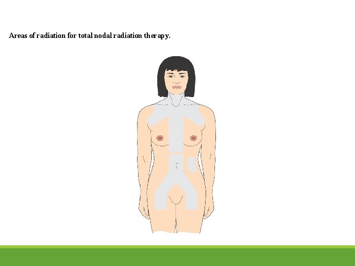 Areas of radiation for total nodal radiation therapy. 