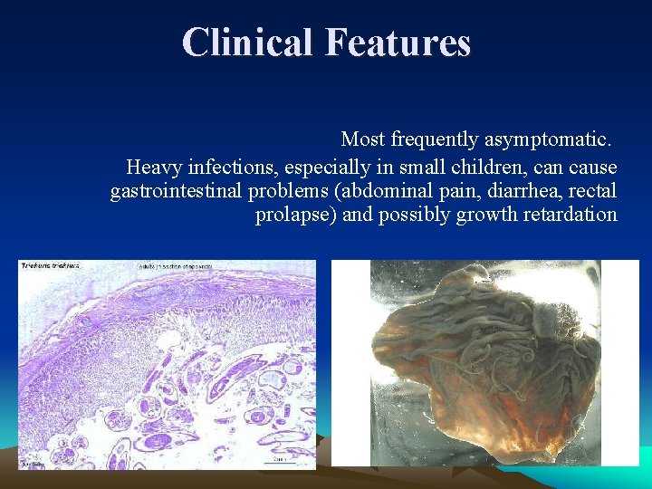 Clinical Features Most frequently asymptomatic. Heavy infections, especially in small children, can cause gastrointestinal