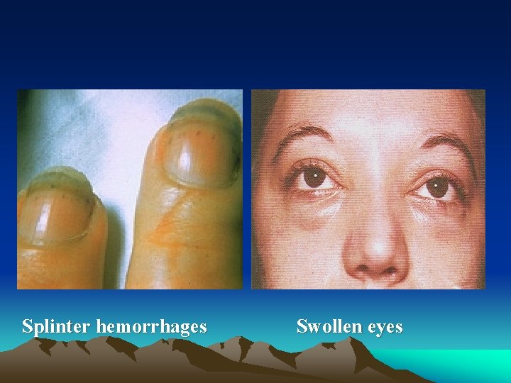  Splinter hemorrhages Swollen eyes 