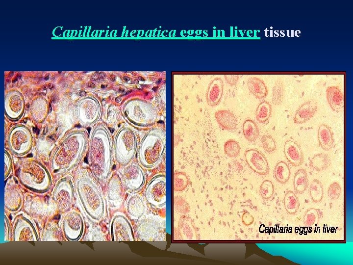 Capillaria hepatica eggs in liver tissue 
