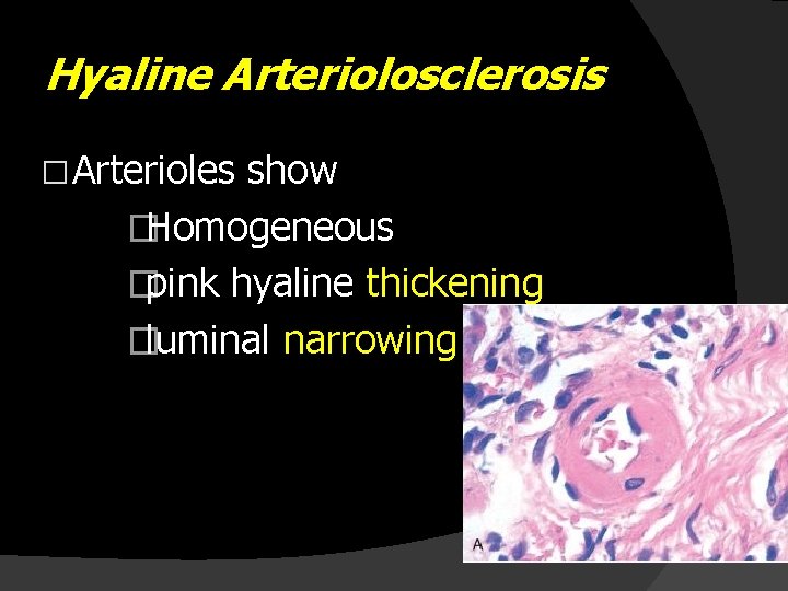 Hyaline Arteriolosclerosis � Arterioles show �Homogeneous �pink hyaline thickening �luminal narrowing 
