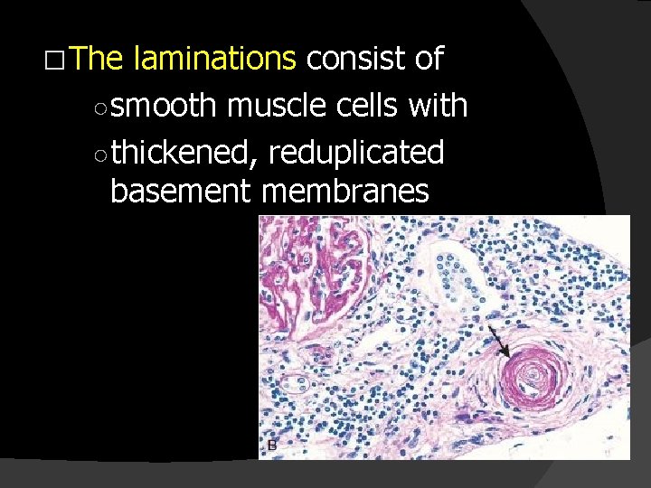 � The laminations consist of ○ smooth muscle cells with ○ thickened, reduplicated basement