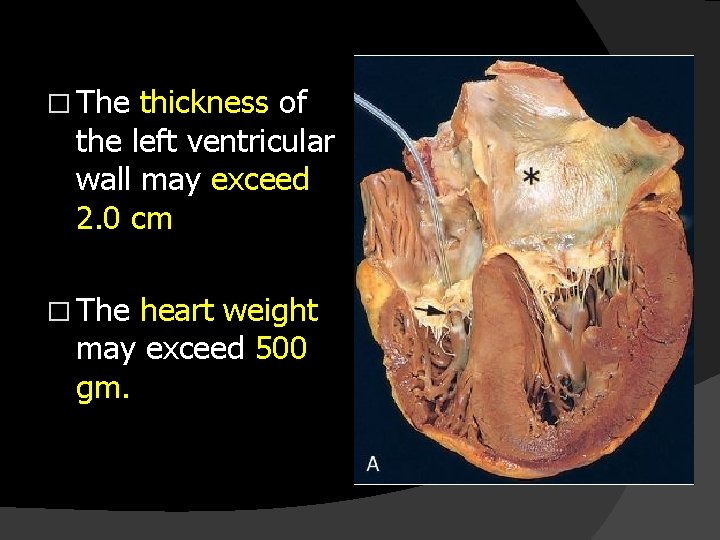 � The thickness of the left ventricular wall may exceed 2. 0 cm �