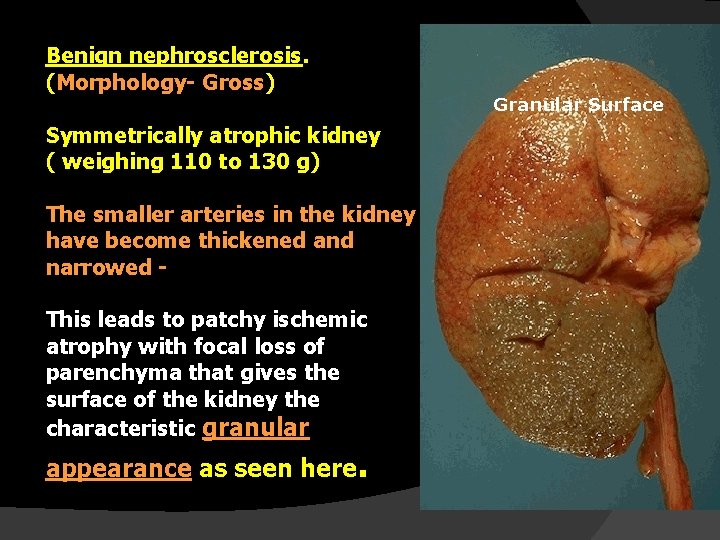 Benign nephrosclerosis. (Morphology- Gross) Symmetrically atrophic kidney ( weighing 110 to 130 g) The