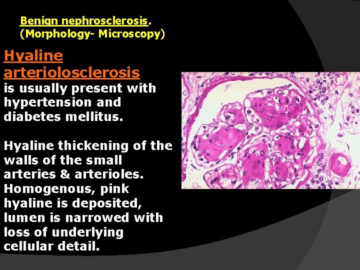 Benign nephrosclerosis. (Morphology- Microscopy) Hyaline arteriolosclerosis is usually present with hypertension and diabetes mellitus.