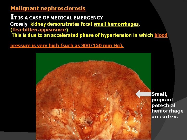 Malignant nephrosclerosis IT IS A CASE OF MEDICAL EMERGENCY Grossly kidney demonstrates focal small