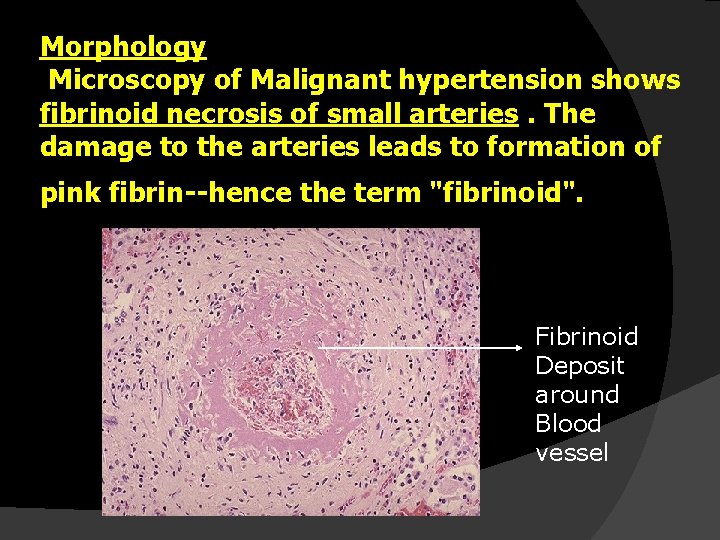 Morphology Microscopy of Malignant hypertension shows fibrinoid necrosis of small arteries. The damage to