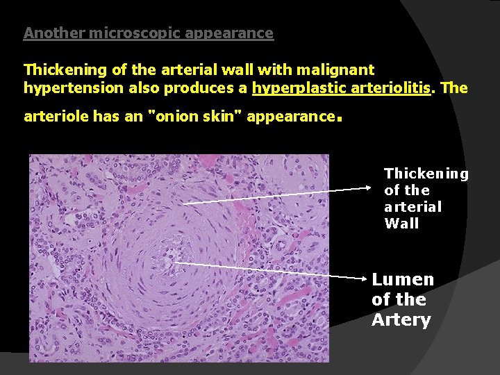 Another microscopic appearance Thickening of the arterial wall with malignant hypertension also produces a