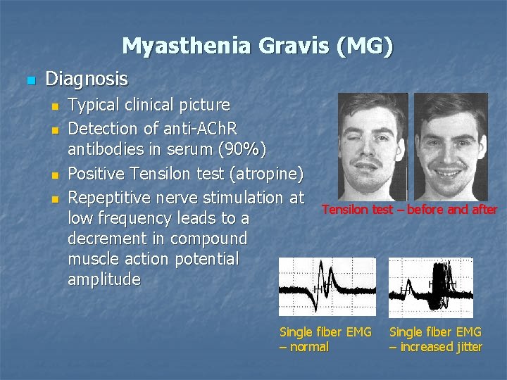 Myasthenia Gravis (MG) n Diagnosis n n Typical clinical picture Detection of anti-ACh. R