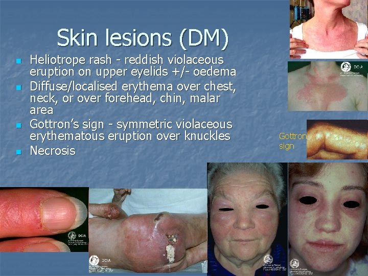 Skin lesions (DM) n n Heliotrope rash - reddish violaceous eruption on upper eyelids