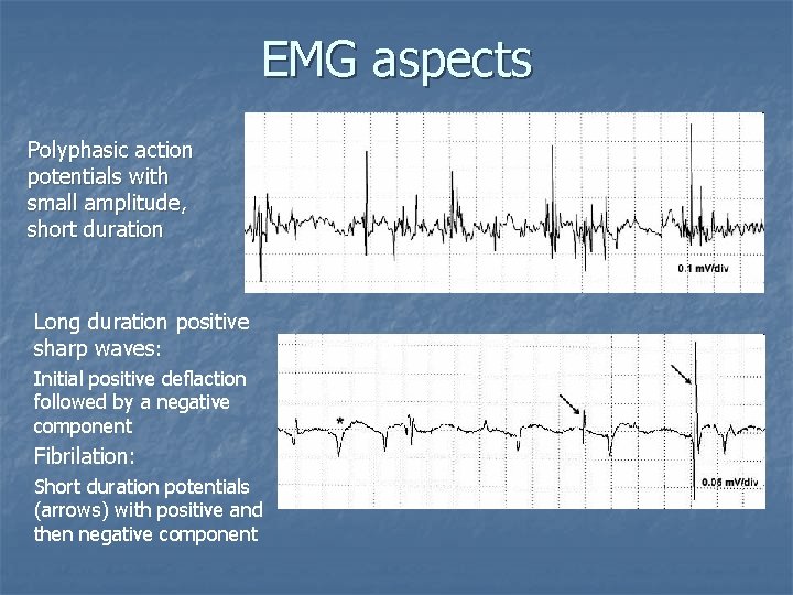 EMG aspects Polyphasic action potentials with small amplitude, short duration Long duration positive sharp
