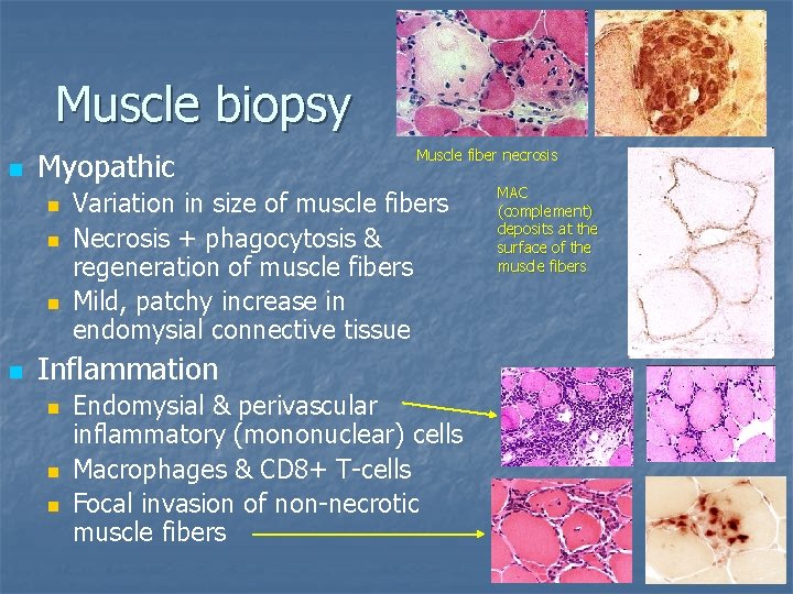 Muscle biopsy n Myopathic n n Muscle fiber necrosis Variation in size of muscle